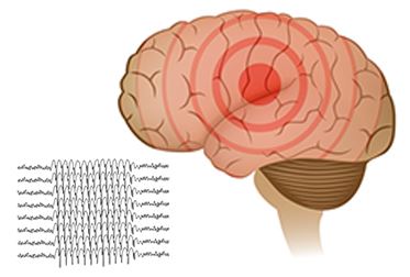 Epilepsi Nöbeti - Sara Nöbeti