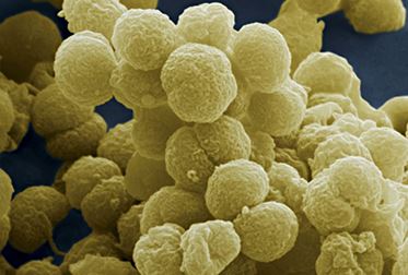 Hpv Virüsünün Rahim Ağzı Kanseri Dışında Başka Hastalık Ve Kanserler İle İlişkisi Varmıdır