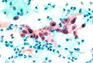 HPV 'Den Toplum Olarak Nasıl Korunabiliriz