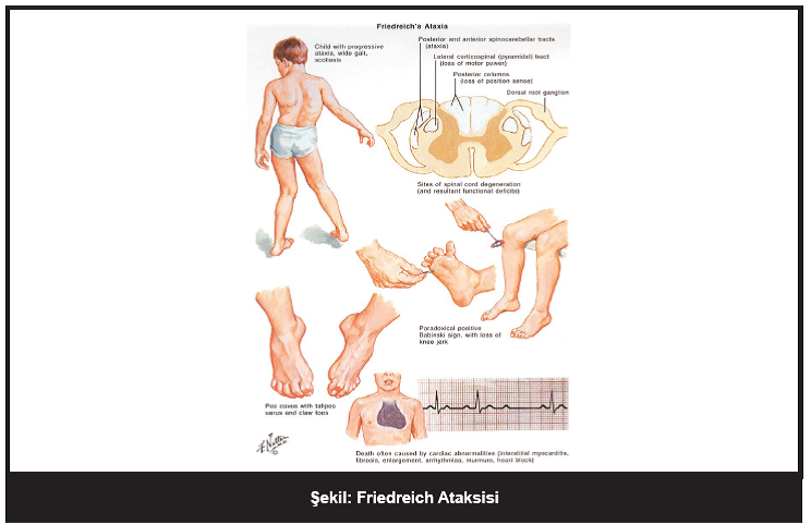 Friedreich Ataksisi Hastaligi Friedreich Ataxia