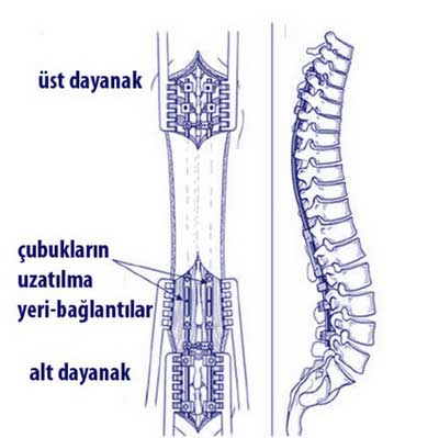 skolyoz-uzatılabilen-cubuk-sistemi
